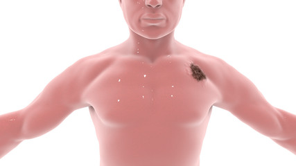 Dépistage des Cancers Cutanés par l'Infirmier 93722100026