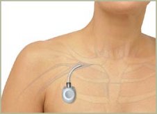 Chambre Implantable & Picc-Line elearning 93722200010